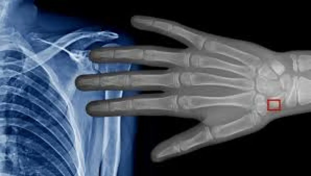 Nueva IA detecta lesiones cerebrales invisibles en niños con epilepsia